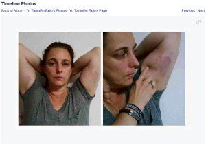 Bruguera-bruises